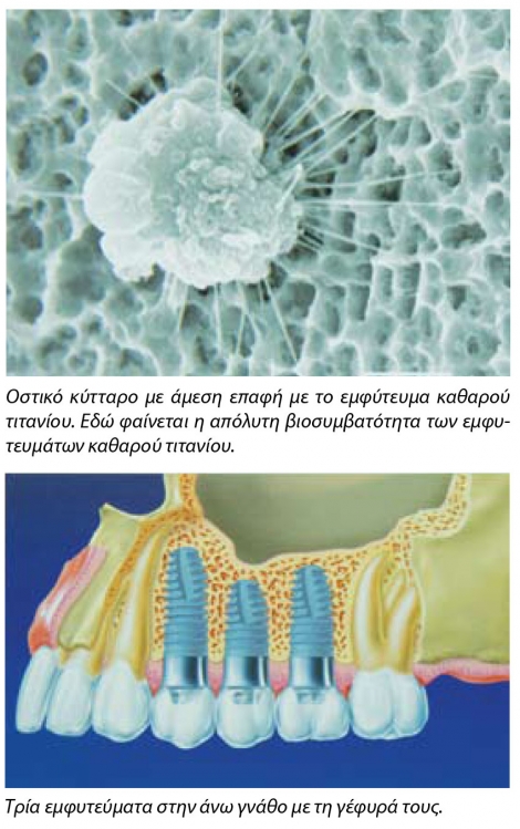 Οστεοενσωματούμενα οδοντικά εμφυτεύματα
